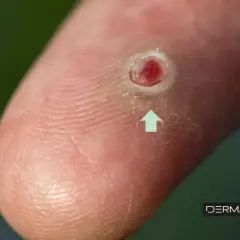 Primer plano de un dedo con una lesión cutánea roja y sangrante, indicando cuando un grano es peligroso.