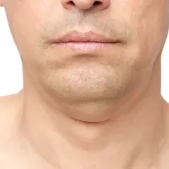 Primer plano de la barbilla y el cuello de un hombre, mostrando papada. Una imagen que ilustra cómo adelgazar la cara.