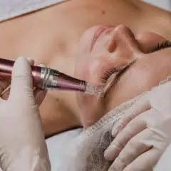 Manos enguantadas realizan microneedling capilar en la frente de una mujer. El dispositivo de microneedling tiene un cabezal con agujas finas.