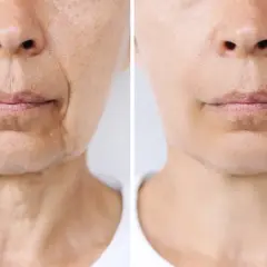 Comparación de piel: antes y después de un tratamiento que podría afectar el "ozempic face", mostrando reducción de arrugas y flacidez.