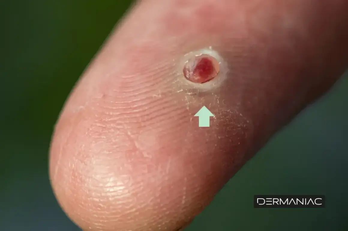 Primer plano de un dedo con una lesión cutánea roja y sangrante, indicando cuando un grano es peligroso.