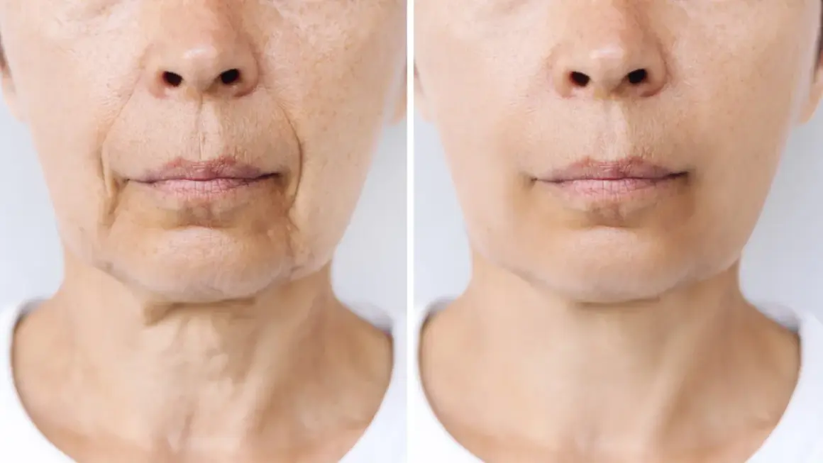 Comparación de piel: antes y después de un tratamiento que podría afectar el "ozempic face", mostrando reducción de arrugas y flacidez.