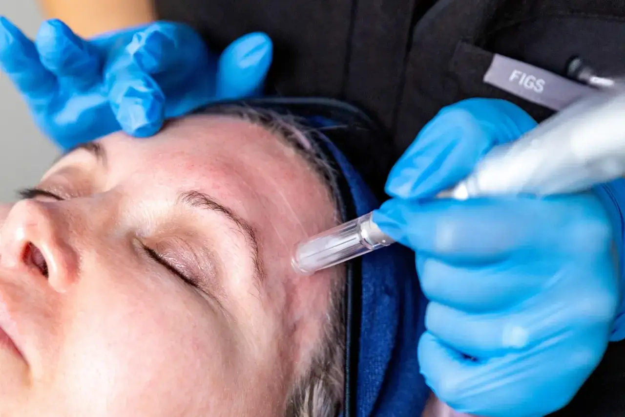 Tratamiento facial con microagujas para estimular el colágeno para la piel. Manos enguantadas aplican el dispositivo en la frente de una mujer.