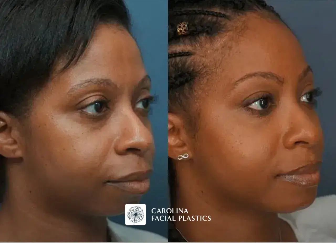 Antes y después de un procedimiento para como adelgazar la cara, mostrando un rostro más definido y contorneado.